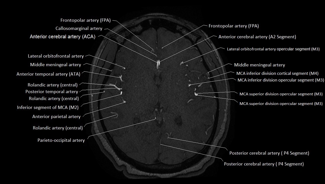MRA brain (cerebral arteries) anatomy axial 3T image 28.webp